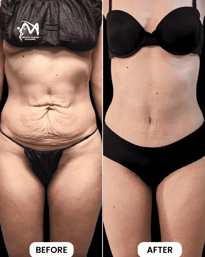 Before and after body transformation in Albania for medical tourism patients.