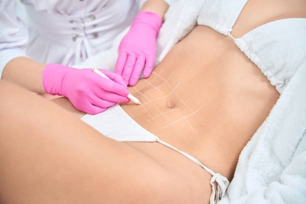 Laparoscopic surgery being performed on a patient's abdomen with pink gloves.